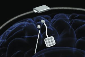 Wireless ‘Pacemaker for the Brain’ Could Be New Standard Treatment for Neurological Disorders